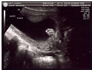Ultrasound of Autumn Holt
