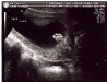 Ultrasound of Autumn Holt